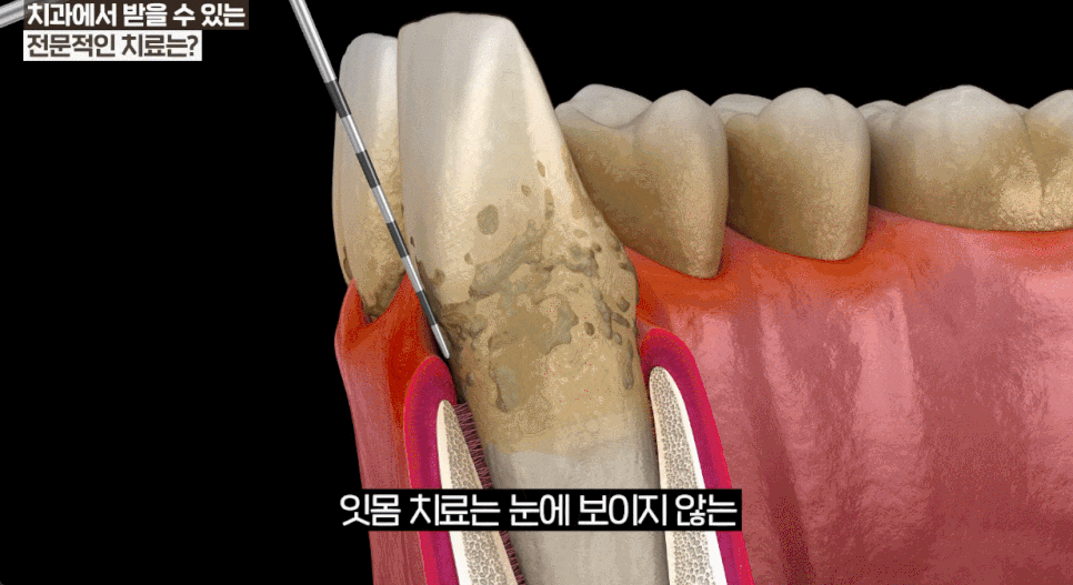 My Gums Hurt: A Complete Guide to Gum Bleeding While Brushing, Home Care, and Dental Gum Treatment image 15