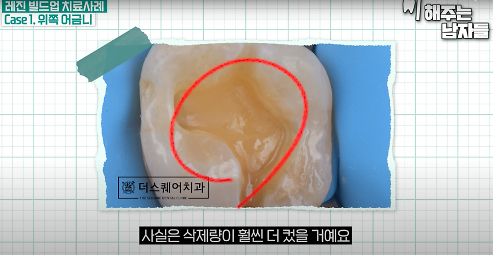 마포충치치료 당일에 끝나는 충치치료, 레진 빌드업이란? 관련 이미지 5