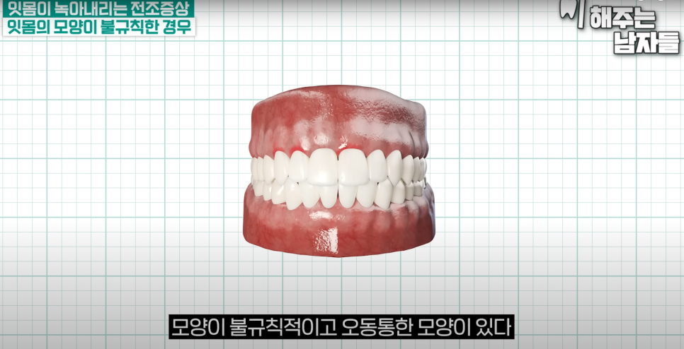 서울역스케일링 잇몸이 보내는 위험 신호, 절대 놓치지 마세요 관련 이미지 4