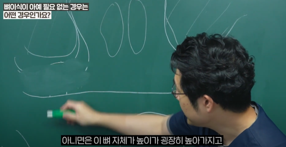 광화문 임플란트 할 때, 뼈이식이 필요한 이유 관련 이미지 8