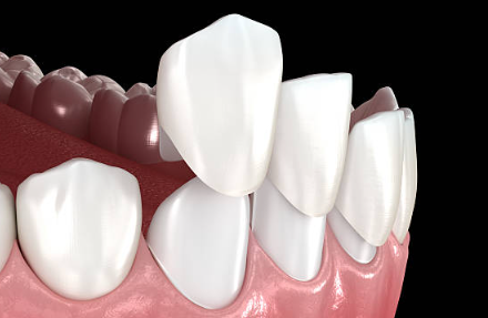 앞니 크라운 교체 시점, 앞니 크라운 수명이 아니라 &lsquo;이 기준&rsquo;입니다. 관련 이미지 6