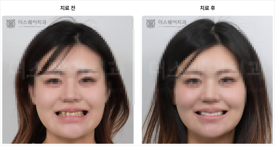 덧니 라미네이트 VS 덧니치아교정, 이 글로 고민 끝내드립니다 관련 이미지 13