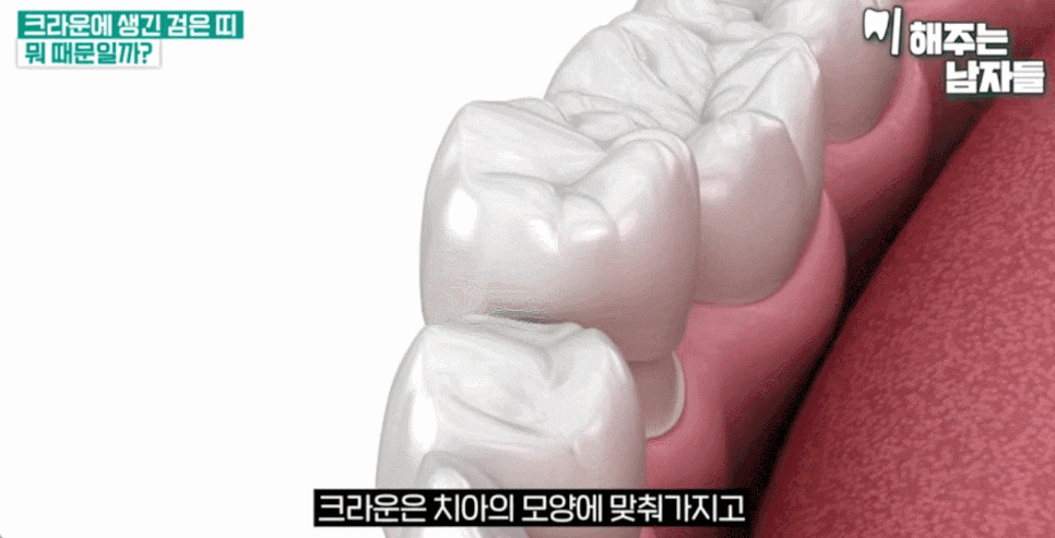크라운 치아 통증, 시간이 지나서 나타나는 이유는 무엇일까요? 관련 이미지 2