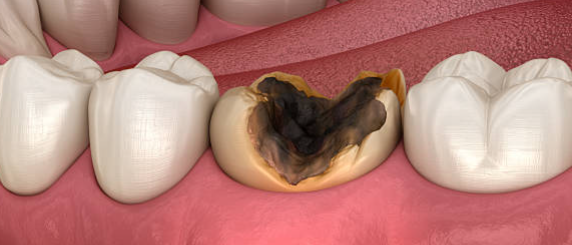 어금니충치깨짐? 레진빌드업치과에서 남아 있는 조건을 먼저 보는 이유 관련 이미지 2
