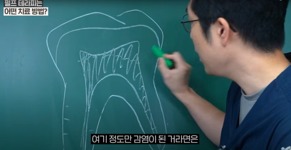 안국역충치치료 치아를 살리는 또 다른 접근, 치수절단술 관련 이미지 3