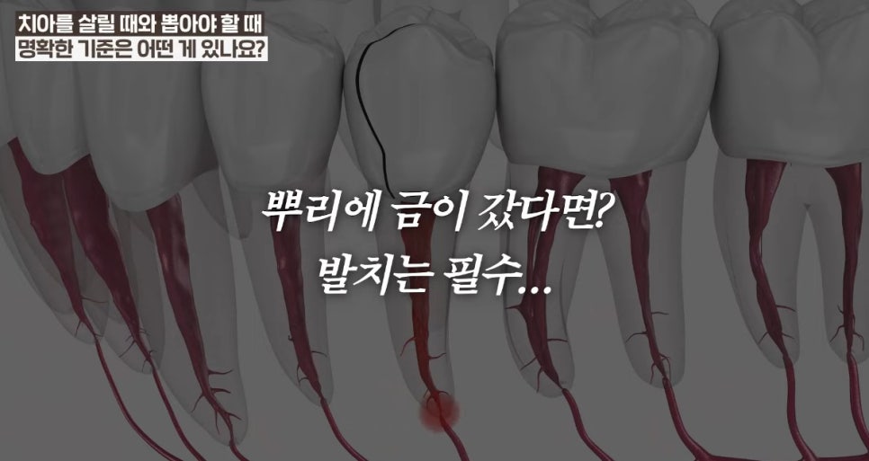 안국역임플란트 치아를 끝까지 살릴 순 없을까요? 관련 이미지 5
