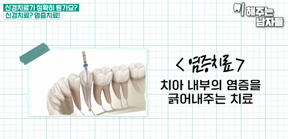 Practical Advice on Root Canal Treatment Duration & Tips for Avoiding Overtreatment image 3