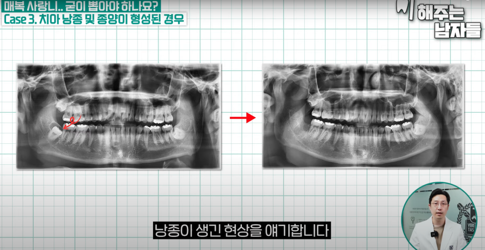 경복궁역사랑니, 안 보이는 사랑니도 발치가 필요한가요? 관련 이미지 6