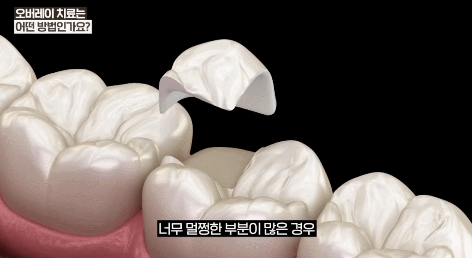 오버레이치과 크라운 단점을 보완한 <오버레이의 모든 것> 관련 이미지 9