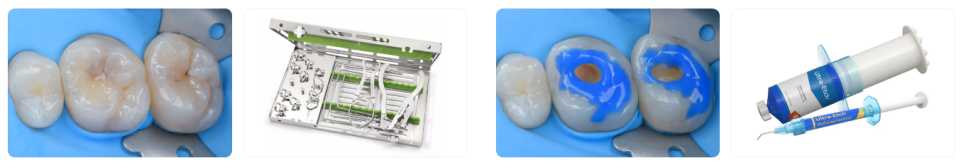 앞니사이벌어짐, 1mm의 선택이 인상을 좌우합니다. [레진빌드업치과] 관련 이미지 7