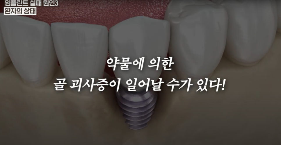 Cheongjin-dong Implants: There Is Clearly a Reason Some People Use Them for Many Years image 3