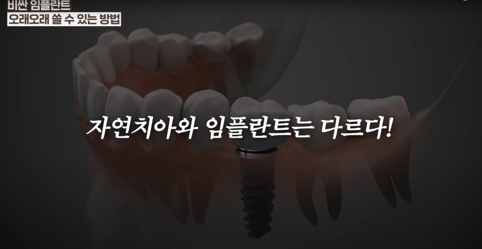 Cheongjin-dong Implants: There Is Clearly a Reason Some People Use Them for Many Years image 7