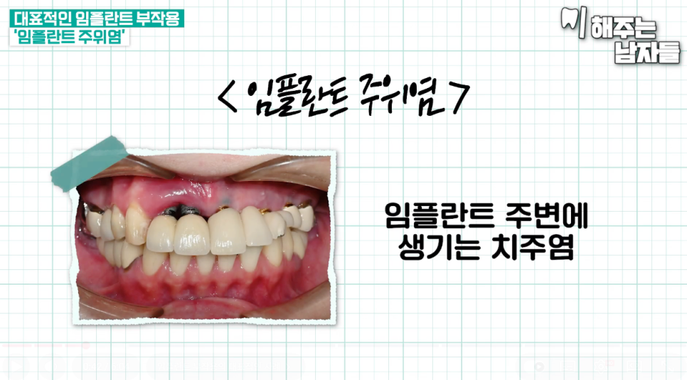 임플란트잇몸부음 원인 및 대처 방안까지 핵심만 요약 관련 이미지 5