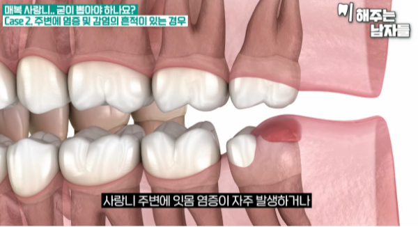 이대치과 매복사랑니, 꼭 발치해야 될까요 관련 이미지 4