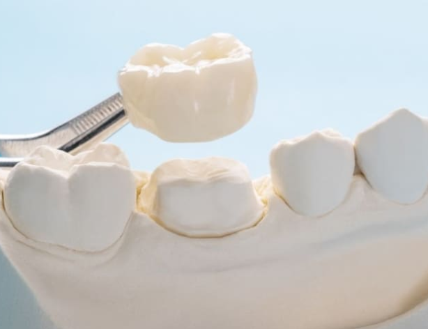 크라운 치아 통증, 시간이 지나서 나타나는 이유는 무엇일까요? 관련 이미지 4