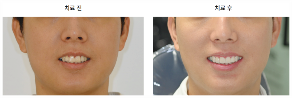 Read This If Veneers at MINISH Dental Clinic Feel Like Too Much image 14