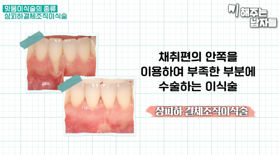 아랫니 잇몸 내려앉음 잇몸이식술로 살려내는 방법 관련 이미지 8