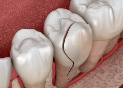 치아 깨졌을때 겉으로 보이는 것만으로 판단하긴 어렵습니다. 관련 이미지 5