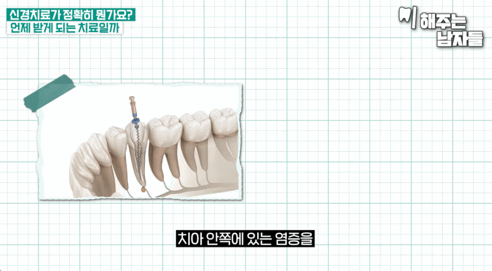 Practical Advice on Root Canal Treatment Duration & Tips for Avoiding Overtreatment image 5