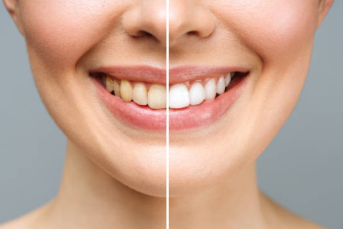 앞니 크라운 교체 시점, 앞니 크라운 수명이 아니라 &lsquo;이 기준&rsquo;입니다. 관련 이미지 8