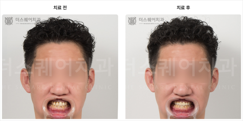 If You’re Unsure Whether to Replace Your Front Tooth Crown, Read This image 8