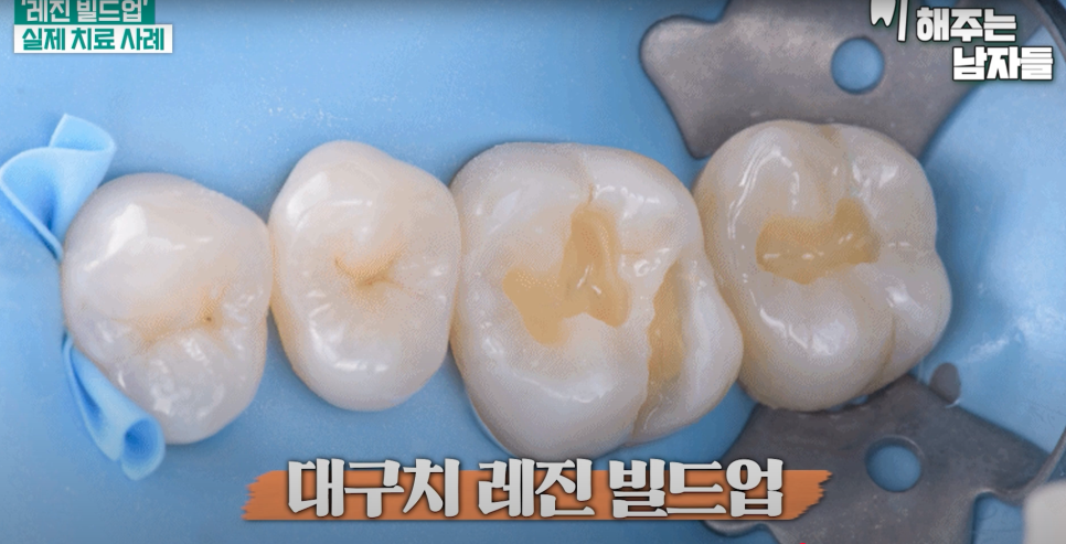 동대문충치치료 자연치아를 최대한 지키는 레진치료의 장점 관련 이미지 3