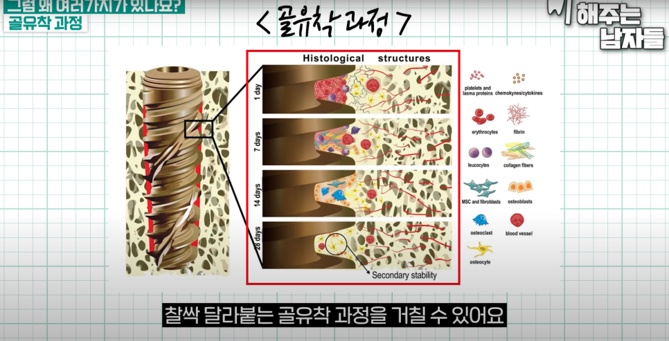 충무로임플란트, 뿌리처럼 단단히 자리 잡게 하는 비밀은? 관련 이미지 2