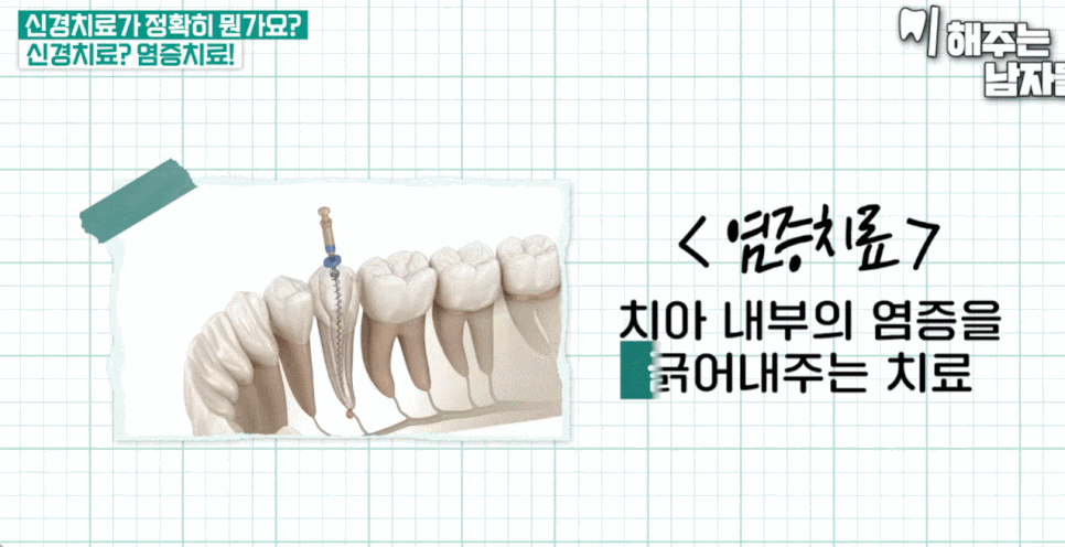 치과 신경치료 통증이 걱정된다면, 신경치료잘하는곳의 기준부터 보세요. 관련 이미지 2