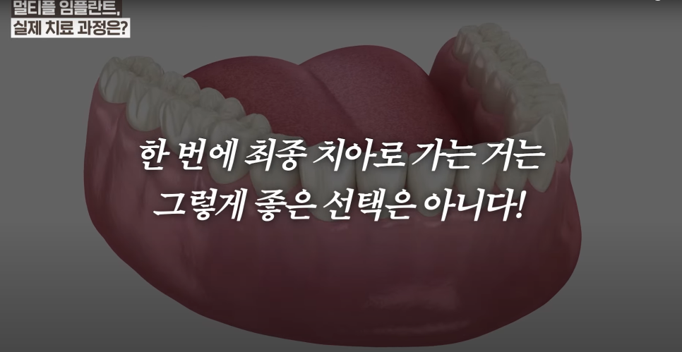 소곡동임플란트 치아가 몇 개만 빠졌을 때, 어떤 치료를 받아야할까? 관련 이미지 8