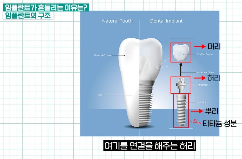 충정로치과, 임플란트가 흔들리는 이유는? 관련 이미지 3