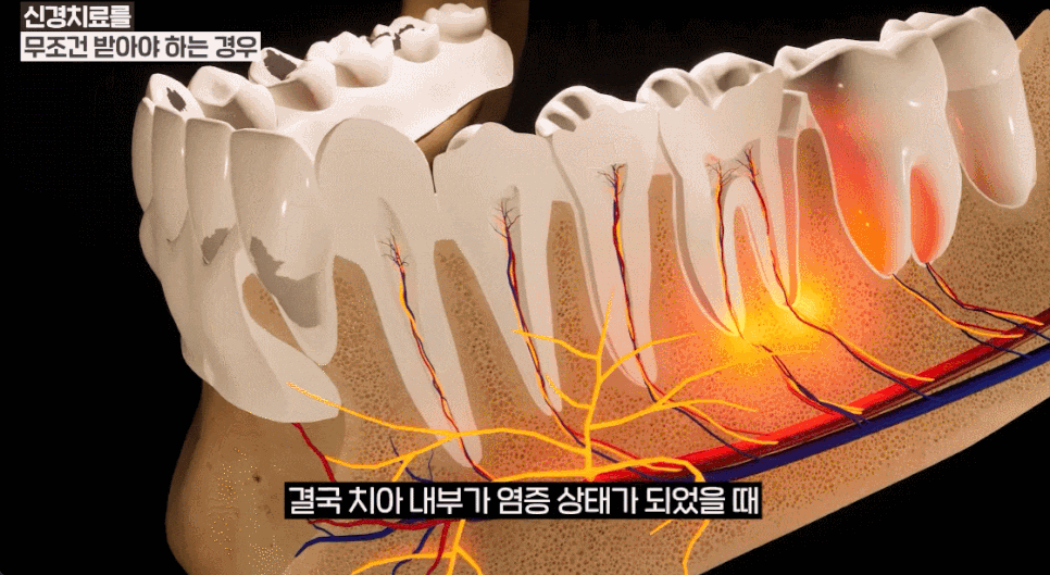 신경치료? 임플란트? 치아 상태를 보면 답이 보입니다. 관련 이미지 2