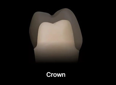 어금니 보철 전, 오버레이크라운 먼저 확인해 보세요. 관련 이미지 3