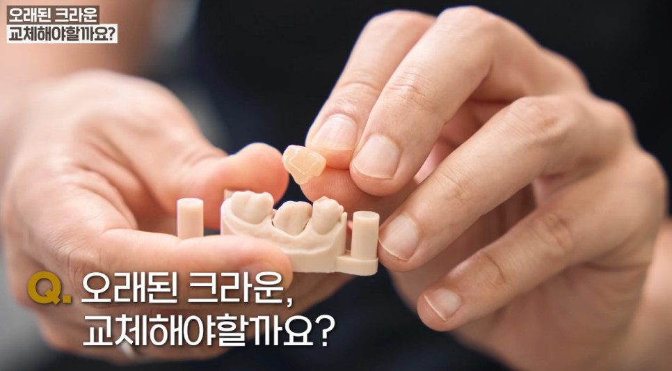 If You’re Unsure Whether to Replace Your Front Tooth Crown, Read This image 2
