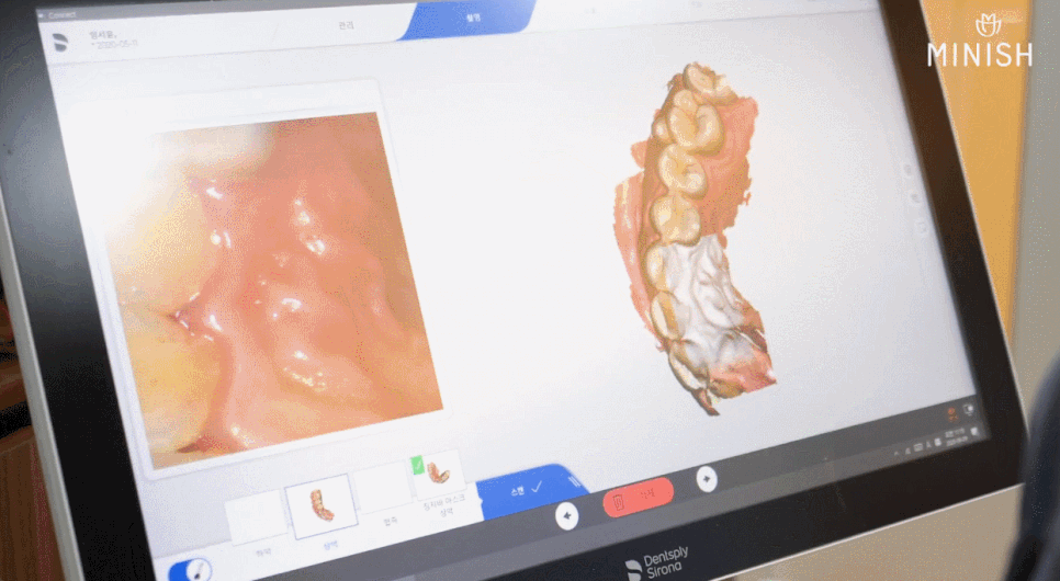 치아 미니쉬 고민 중이라면, 결정 전에 꼭 봐야 할 3가지 기준 관련 이미지 6