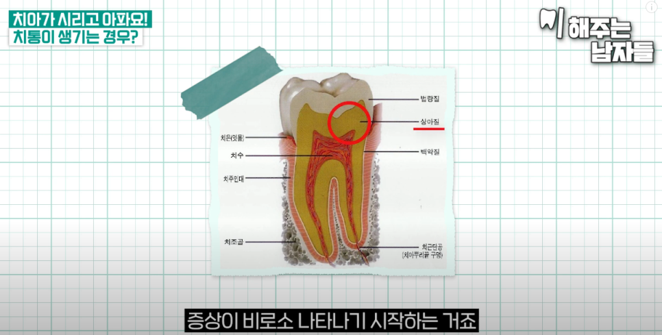 서울중구치과 치아 크랙, 그냥 지나치면 안됩니다 관련 이미지 4