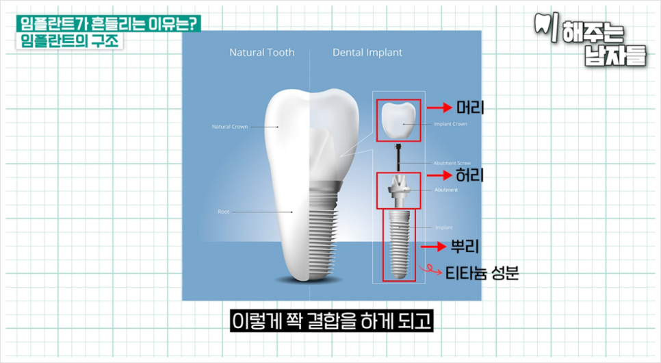 임플란트빠짐 & 흔들림, 당장 치과 가야 하는 이유와 대처법까지 관련 이미지 4