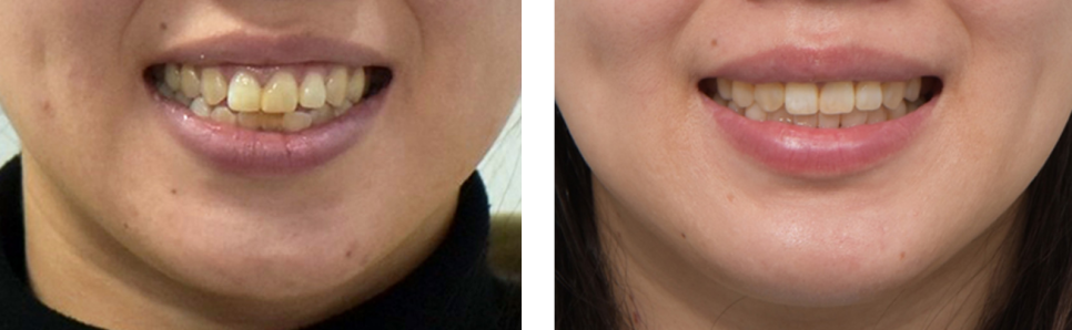 Why 30s Dental Correction Is Necessary and How to Straighten Your Teeth Without Drawing Attention image 7
