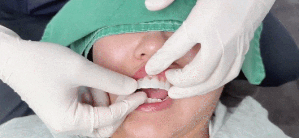 심미보철, 결과를 먼저 확인하고 결정합니다. [스마일리허설] 관련 이미지 6