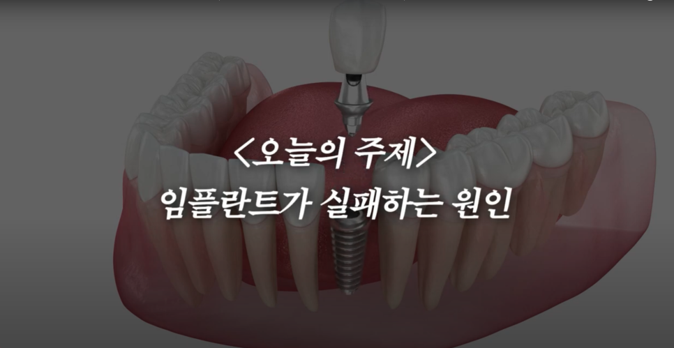 Cheongjin-dong Implants: There Is Clearly a Reason Some People Use Them for Many Years image 1