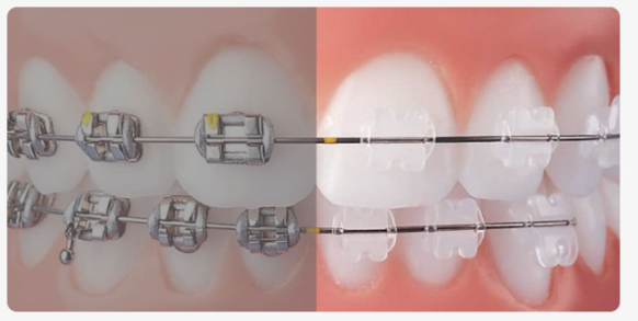 치아교정기종류, 눈에 안 보이는 장치가 더 좋을까요? 관련 이미지 3