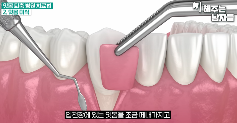 서울역사랑니 치아 블랙트라이앵글, 어떻게 해야 될까요? 관련 이미지 7