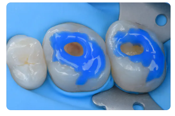 어금니충치깨짐? 레진빌드업치과에서 남아 있는 조건을 먼저 보는 이유 관련 이미지 8