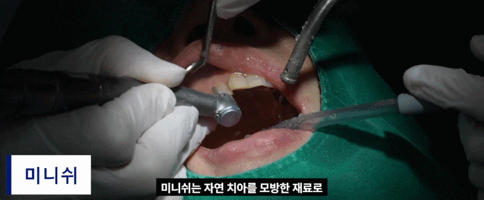 치아교정기간이 부담될 때, 미니쉬교정이 답이 되는 경우는 따로 있습니다. 관련 이미지 2