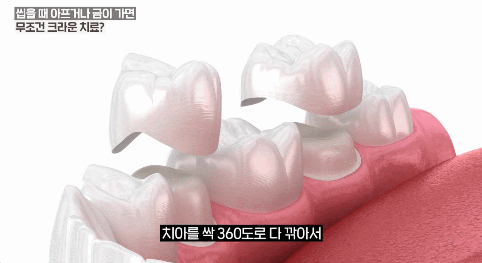 어금니크라운종류 장단점 이 글 하나로 완벽히 비교해 드립니다 관련 이미지 11