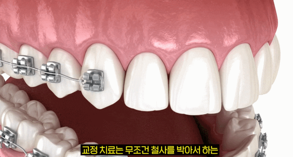 치아교정기간이 부담될 때, 미니쉬교정이 답이 되는 경우는 따로 있습니다. 관련 이미지 4