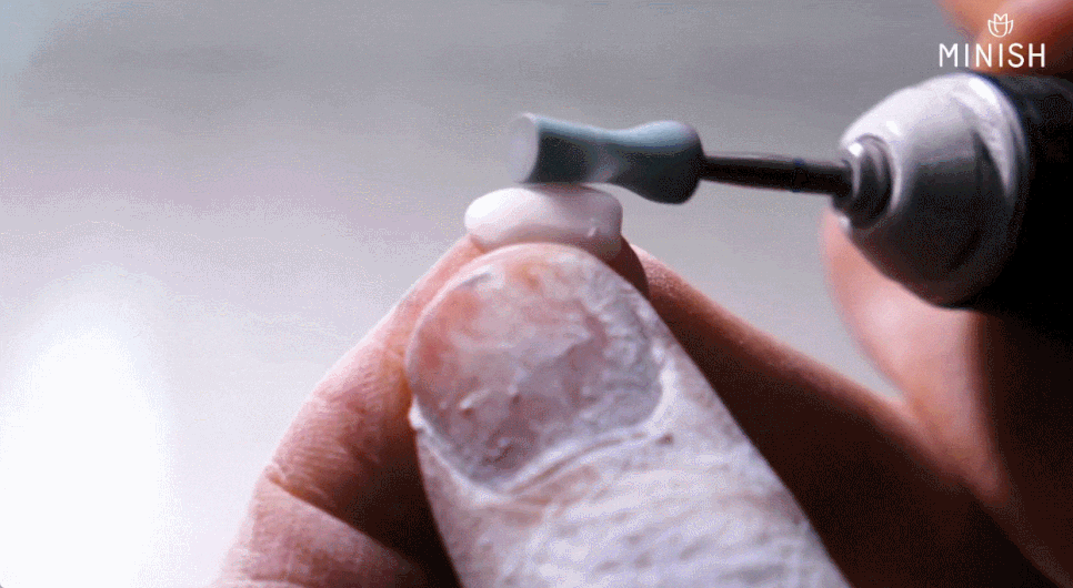 Read This If Veneers at MINISH Dental Clinic Feel Like Too Much image 13