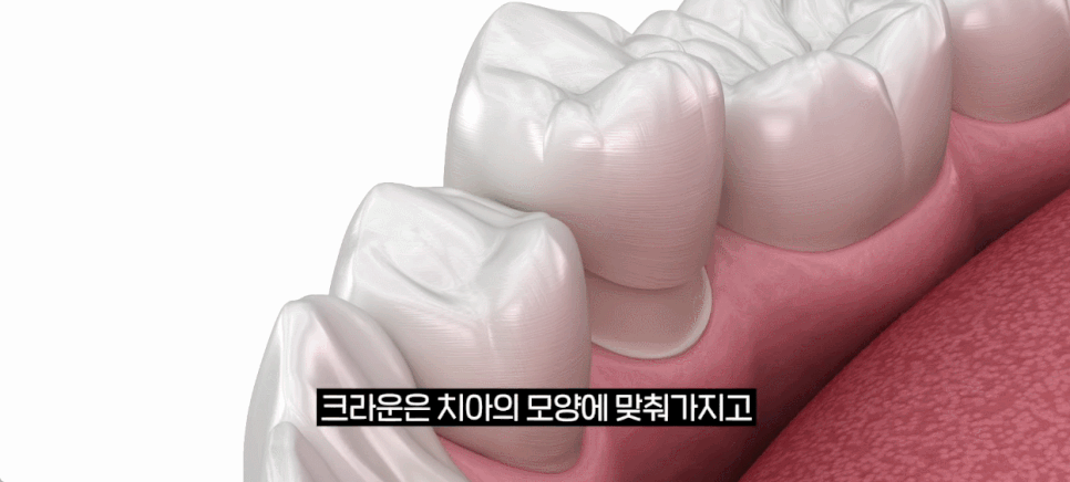 Crown vs. Overlay Treatment for a Cracked Molar Explained image 7