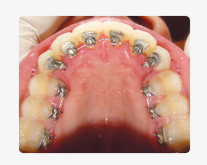 치아교정기종류, 눈에 안 보이는 장치가 더 좋을까요? 관련 이미지 5