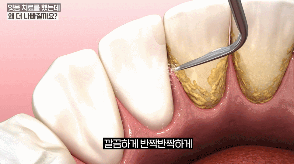 만성치주염 VS 급성치주염 증상별 차이와 치료법 총정리 관련 이미지 10