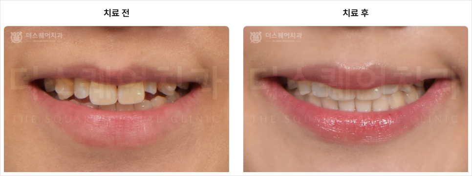 왜소치 교정, 작은 치아 무작정 키우기 전 알아야 할 팩트 관련 이미지 9